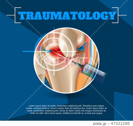 Realistic Illustration Traumatology Medicine in 3d Realistic Illustration Traumatology Medicine in 3d 47322200