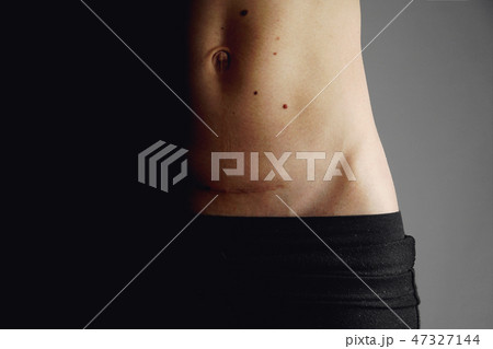 Closeup of woman belly with a scar from a cesarean section Closeup of woman belly with a scar from a cesarean section 47327144