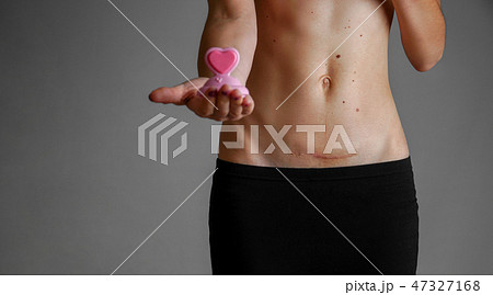 Closeup of woman belly with a scar from a cesarean section 47327168