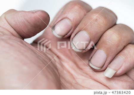 dirty fingernails unhealthy pile up germ unclean 47363420