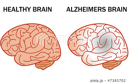 アルツハイマー型認知症の脳イラストのイラスト素材