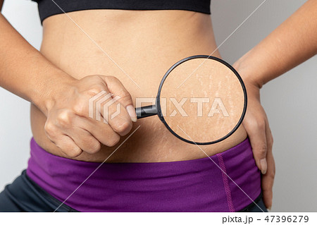 Women Show off the belly after birth. Stretch Mark Women Show off the belly after birth. Stretch Mark 47396279