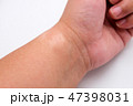Close up: A scar on left wrist on white background 47398031
