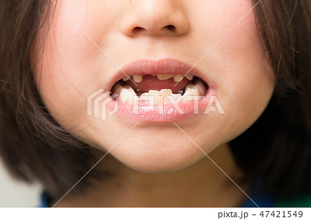 ガタガタの歯並びの女の子 47421549