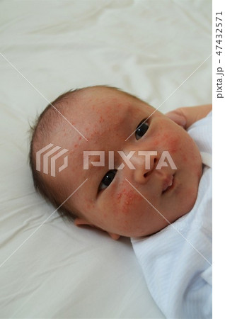 乳児湿疹の写真素材