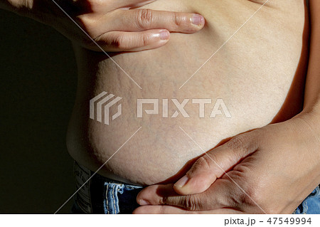 ストレッチマーク　女性　お腹 47549994