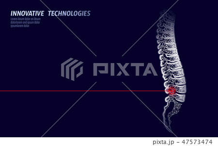 Laser physiotherapy human spine injury. Pain area surgery operation modern loin medicine technology 47573474