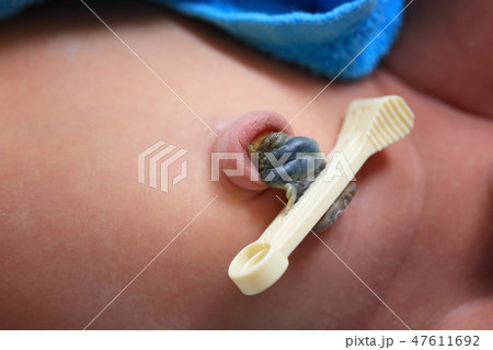 umbilical cord of the baby. 47611692