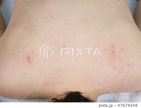 White and red pimples and acne on the man's back. 47679349