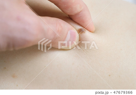 Man's hand touches the mole on the woman's skin. Doctor medical screening. Close up hand and mole. Man's hand touches the mole on the woman's skin. Doctor medical screening. Close up hand and mole. 47679366