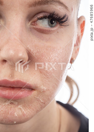 skin after peeling 47685966