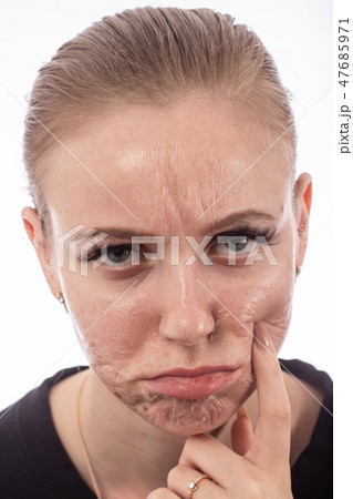 skin after peeling 47685971