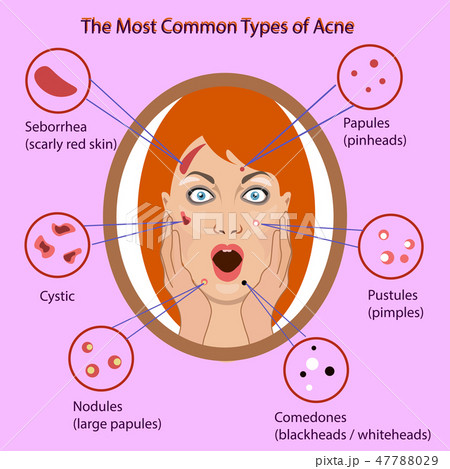 Different type of acne. Vector Illustration with skin problems. woman face isolated Different type of acne. Vector Illustration with skin problems. woman face isolated 47788029