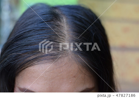 Hair loss, baldness and dandruff on the scalp 47827186