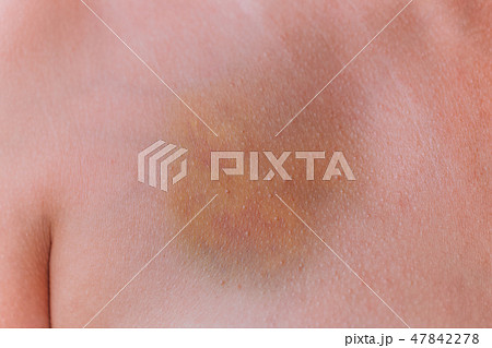 real huge yellow, red and blue bruise at breast real huge yellow, red and blue bruise at breast 47842278