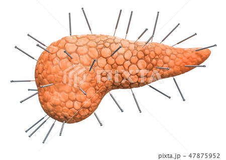 Human pancreas with acupuncture needles 47875952