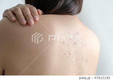 Woman with dermatology skin Dermatologist Woman with dermatology skin Dermatologist 47915195