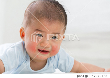 Skin rashes in babies concept 47970488