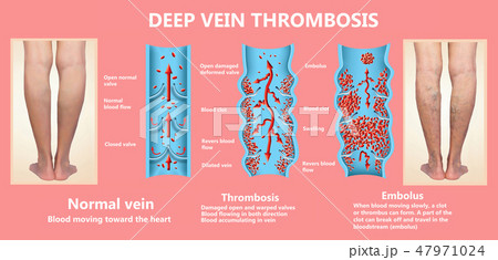 thrombosis. From Normal blood flow to Blood clot formation 47971024