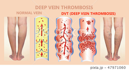Deep Vein Thrombosis or Blood Clots. Embolus. Deep Vein Thrombosis or Blood Clots. Embolus. 47971060