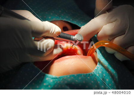 Teeth scaling 48004010