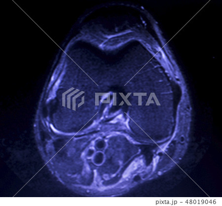 MRI knee meniscus tear scan 48019046