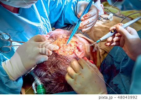Facial plastic surgery operation. Face lift surgery. Surgeon separated the skin from the patient's Facial plastic surgery operation. Face lift surgery. Surgeon separated the skin from the patient's 48043992