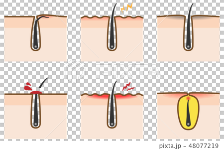 脫毛皮膚問題的插圖 如埋藏的毛髮和毛囊炎 插圖素材 圖庫