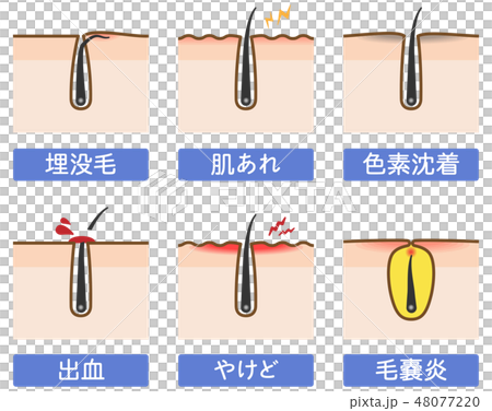 埋没毛や毛嚢炎など脱毛肌トラブルのイラストのイラスト素材