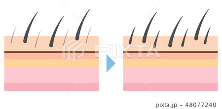 脱毛トラブルの多毛化のイラスト 48077240
