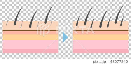 脱毛トラブルの多毛化のイラスト 48077240