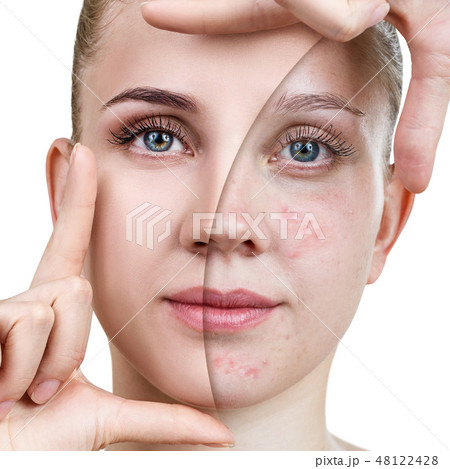 Young woman before and after skin treatment and makeup. 48122428