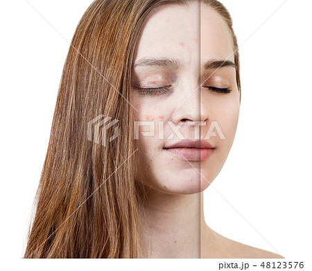 Young woman before and after skin treatment and makeup. Young woman before and after skin treatment and makeup. 48123576