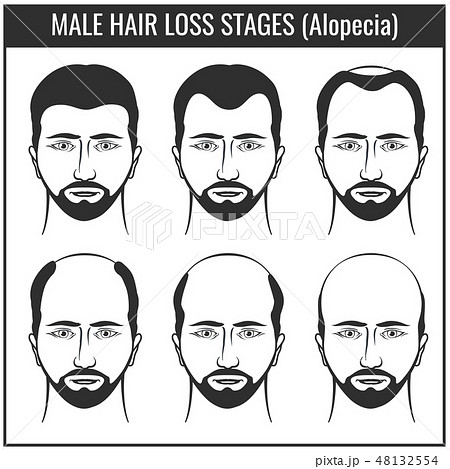 Hair Loss Stages And Types Of Baldness Man のイラスト素材