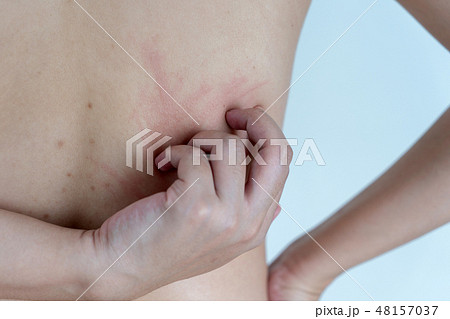 Woman Dermatologist examining birthmark of  48157037