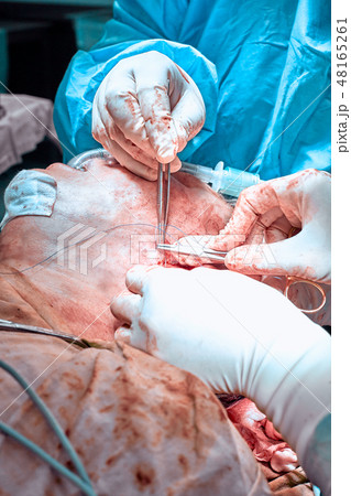 Facial plastic surgery operation. Face lift surgery. Surgeon separated the skin from the patient's Facial plastic surgery operation. Face lift surgery. Surgeon separated the skin from the patient's 48165261
