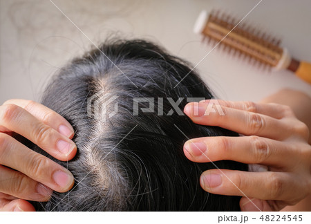 hair fall and lost alopecia woman problem hair fall and lost alopecia woman problem 48224545