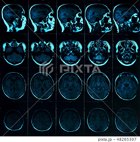 Magnetic resonance scan of the brain with skull Magnetic resonance scan of the brain with skull 48265307