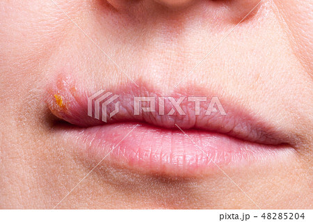 Herpes on the lip close up macro Herpes on the lip close up macro 48285204