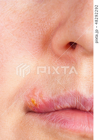 Herpes on the lip close up macro Herpes on the lip close up macro 48292292