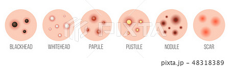 Creative vector illustration types of acne, pimples, skin pores, blackhead, whitehead, scar Creative vector illustration types of acne, pimples, skin pores, blackhead, whitehead, scar 48318389