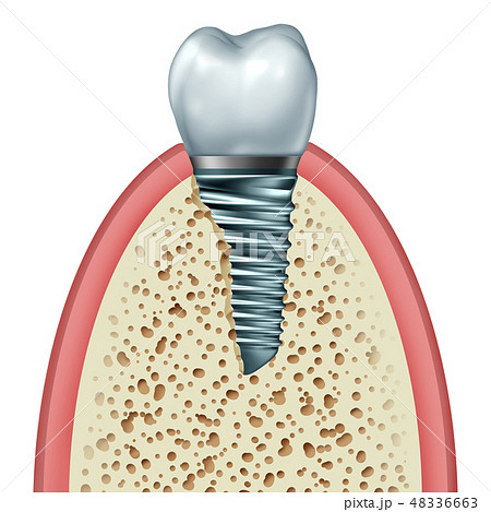 Tooth Implant Tooth Implant 48336663