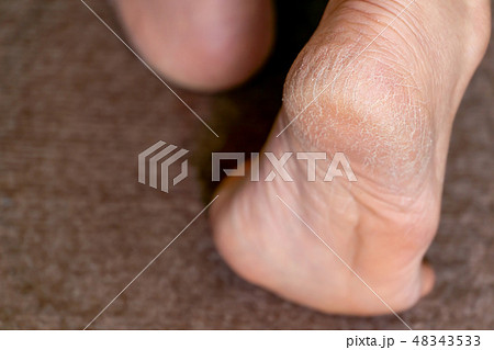中高年女性のかかと ひび割れ 角化症 中高年女性のかかと ひび割れ 角化症 48343533