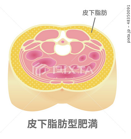 腹部断面図イラスト 肥満のタイプ 皮下脂肪型肥満のイラスト素材