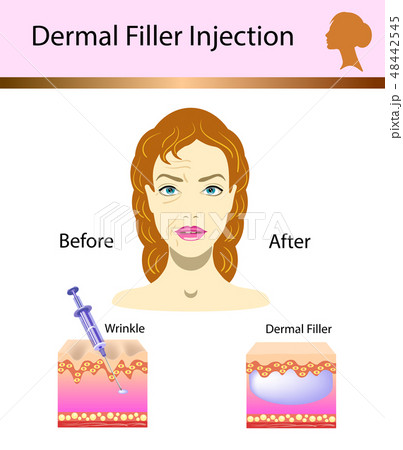 Vector illustration with cosmetic filler  Dermal  48442545
