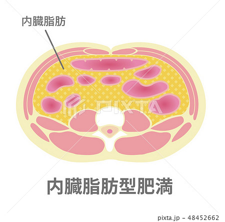腹部断面図イラスト「肥満のタイプ」/ 内臓脂肪型肥満 48452662