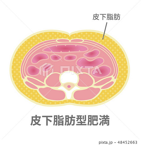 腹部断面図イラスト 肥満のタイプ 皮下脂肪型肥満のイラスト素材