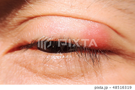 Blepharitis or Eyelid inflammation healthy eyes 48516319