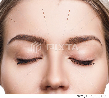 Woman undergoing acupuncture treatment. Woman undergoing acupuncture treatment. 48538423