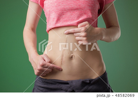 Woman with long abdominal scars after operation 48582069